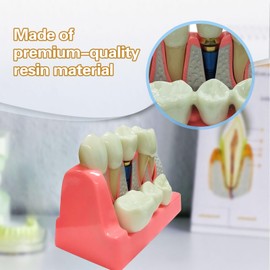Windplusya Dental Implant Model 4 Times Implant Teeth Model, Analysis Crown Bridge Removable Model Dentistry Stutent Study and Dentist Teaching.