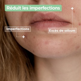 Mixa Reinigungsmittel Komfort gegen Unreinheiten mit Salicylsäure und Squalan