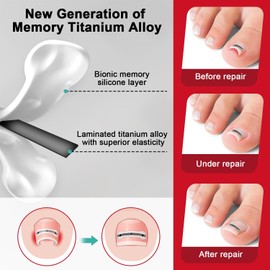 INGROWN TOENAIL TREATMENT KIT