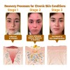Mzhl Crema Awzlove For Reducir Las Imperfecciones De La