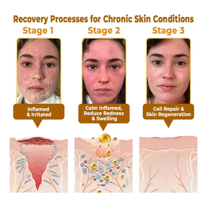 Mzhl Crema Awzlove For Reducir Las Imperfecciones De La