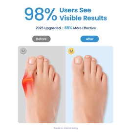 Habioer Bunion Corrector for Women and Men, Breathable Big Toe Straightener, Bunion Relief Splint & Pad, Comfortable for Day/Night Use, Fit for R/L, Washable