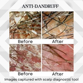 Abera Anti-Dandruff Shampoo for Stronger Hair & Healthier Scalp, Nourishes, Supports and Promotes Hair Growth, Get Rid of Dandruff, 6.67 fl oz, Set of 2