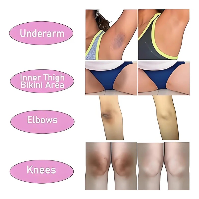 Crema Despigmentante Vaginal Peritoanal Axilas Entrepiernas Neutra