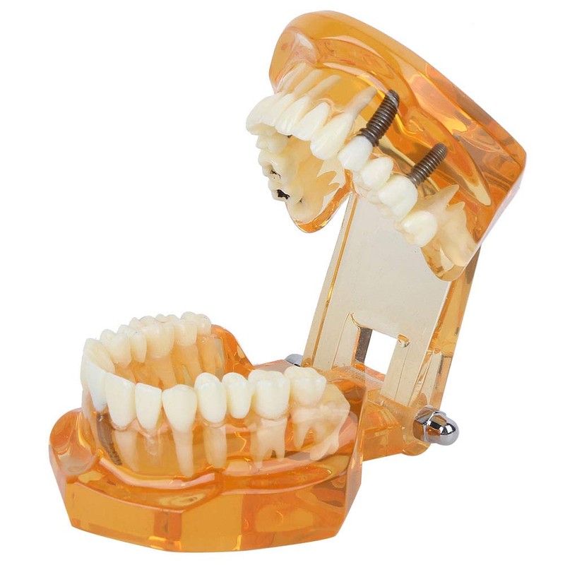 Dental Model Dental Disease Teaching Model Removable Implant Teeth Model