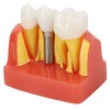Dental Implant Teeth Model, Dental Implant Analysis Crown Bridge Model,