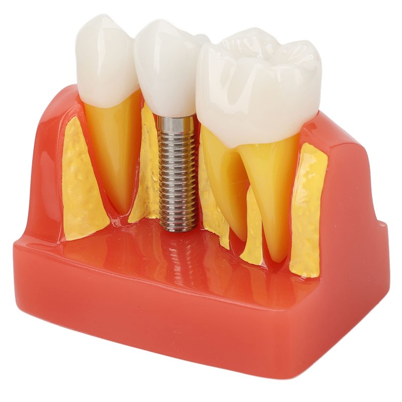 Dental Implant Teeth Model, Dental Implant Analysis Crown Bridge Model,