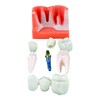 Dental Implant Educational Model, 4X Size, Demonstration Crown and Bridge