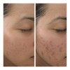 Crema De Noche Anti Acné Paño Y Manchas + Agua