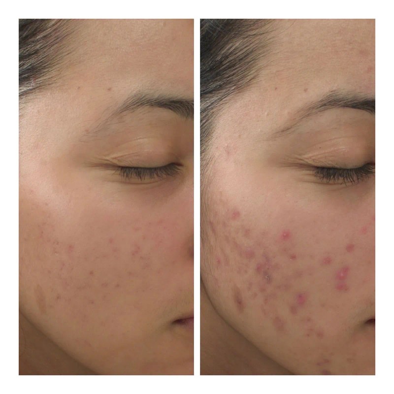 Crema De Noche Anti Acné Paño Y Manchas + Agua