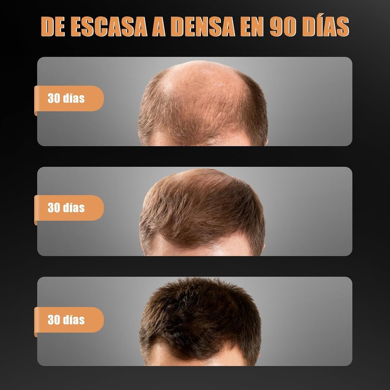 2PCS Champú Anticaída，Reduce la caída del cabello，tratamiento Reparador Capilar, Para