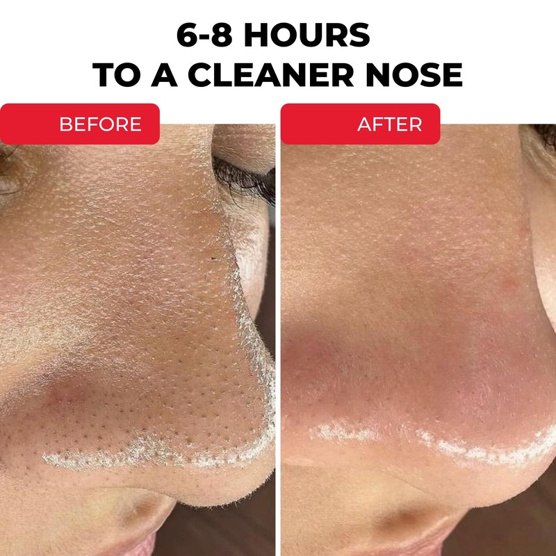 HydroClear Nose Patches – Anti-Acne & Blemish Remover for T-Zone