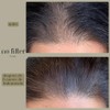 No Filter Beauty Kit de Microinfusión Capilar Hair Growth para