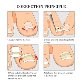 10Pcs White Ingrown Toenail Correction Strips Brace Kit,Strips Recover Clips Toenails Thick Pedicure Tool Toenail Straightener Strip for Men Women Foot Care Tool Gr,Nail Tools, Tools and Accessories