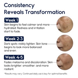 Melasma Treatment for Face - Melasma Cream & Age Spot Remover for Skin Discoloration, Post-Blemish Marks, Scars & Spots | Dark Spot Remover for Face & Body
