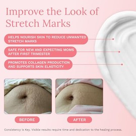 Rejuvaskin Crema Antiestras Resolve 90ml - Tratamiento Intensivo para Estras - Previene y Reduce Cicatrices de Embarazo y Peso                        