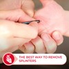 Ever Ready First Aid Splinter Out Splinter Remover, Pack of