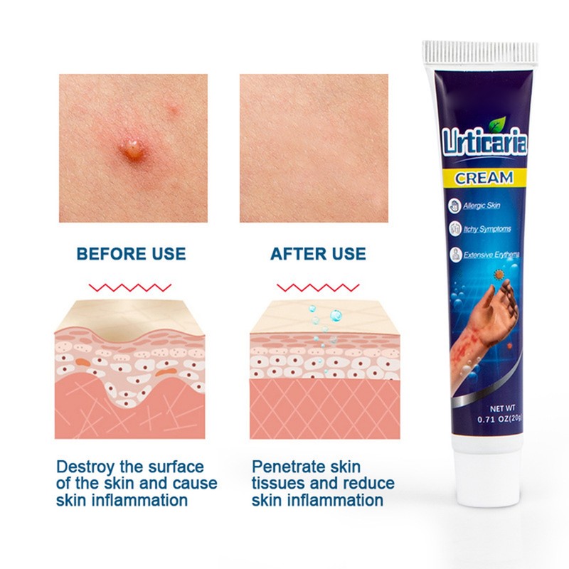 Urticaria Antipruritic Cream 20g Natural Herbal Anti Itch Ointment
