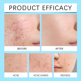 Retinol Gel,Acne Treatment Gel,Acne Control Cream for Face,Anti Acne Gel for Spot Prone Skin,Retinol Moisturizer Cream,Brightens Skin and Improves Elasticity,Face for Pimple Reduce,Without Over Drying