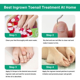 Ingrown Toenail Treatment Kit, Relieve Ingrown Toenail Pain, Repair Ingrown Toenail Issues, Safe and Convenient Home Solution