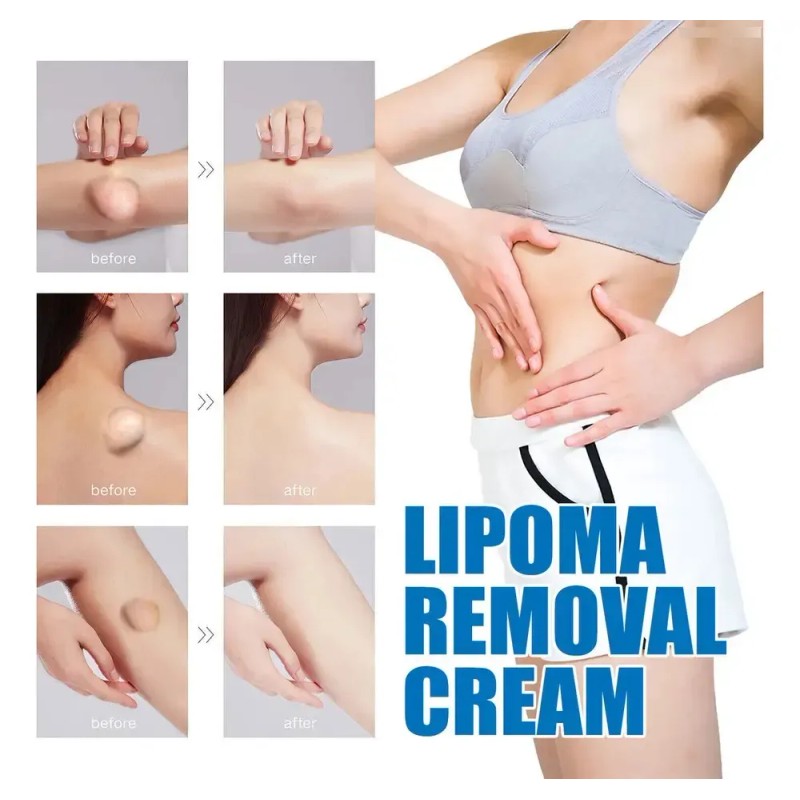 Jx Crema Limpiadora Para Lipomas Nc4c, Bloqueadora Grasa, 1