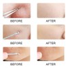 KAV Comedone Extractor Kit 5-Piece Blackhead Remover Tool Set with