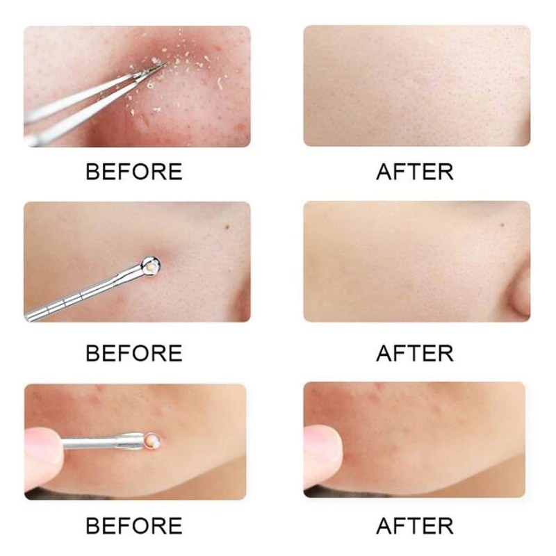 KAV Comedone Extractor Kit 5-Piece Blackhead Remover Tool Set with