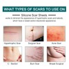 Silicone Scar Sheets (1.6” x 120” Roll-3M), Silicone Scar Tape