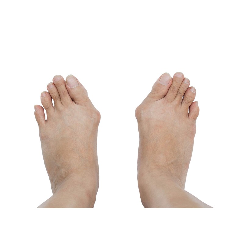 Pedag Bunion Protector, Soft Gel Bunion Shield Guard Cushion