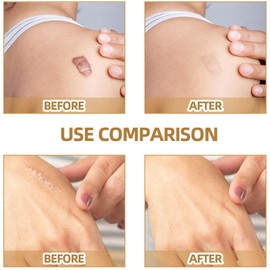 6pcs A Kit Tat/too Cover Up Tape,Tat/too Cover Up Sticker,Invisible Scar Cover-Up tat/too Cover Up Patch,Skin Scar Cover Tape,Breathable Tat/too Concealing Tape,Natural Concealer Stickers,Scar Patches