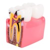 Modelo de encía dental, modelo de estudio comparativo de caries