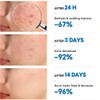No Brand Real and effective Acne Pimple Cream 祛痘膏祛痘乳霜 20g
