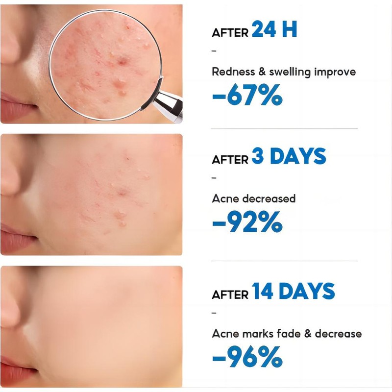 No Brand Real and effective Acne Pimple Cream 祛痘膏祛痘乳霜 20g
