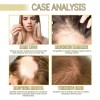 Aceite Esencial Eelhoe Rosemary Hair Care, Reparador Del Cab