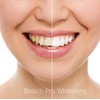 Teeth Whitening Gel Syringe Dispensers 22% Carbamide Peroxide, 10 Tooth