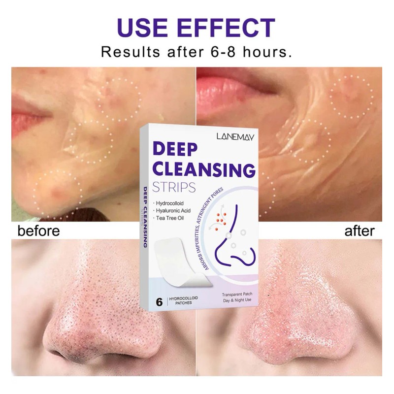 Tiras Nasales Limpiadoras For Eliminar Puntos Negros, &ac