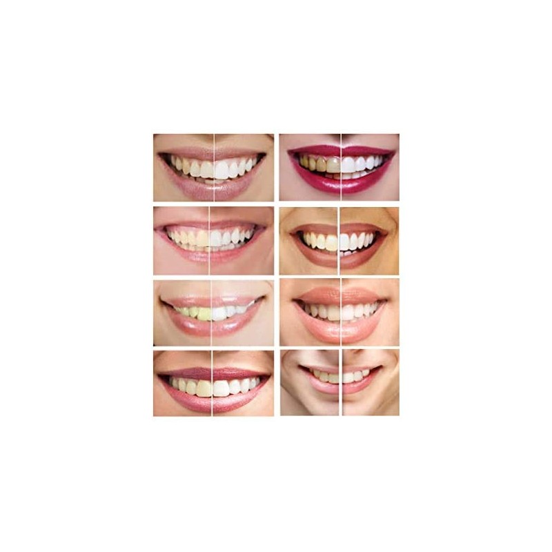 Teeth Whitening Gel Syringe Dispensers 35% Carbamide Peroxide, Tooth Bleaching