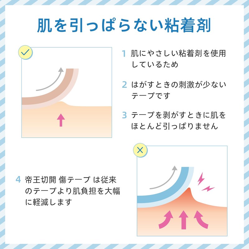 [ESSENTIAL DERMATOLOGIST RECOMMEND] Scar Care Tape Keloid Tape for Protection,
