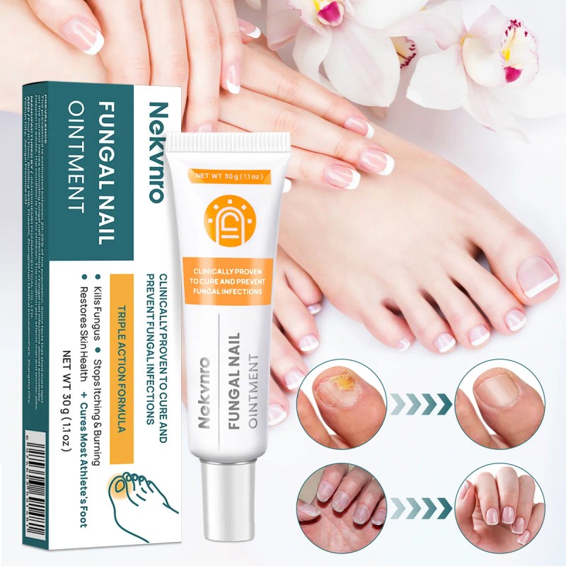 Pomada Antifúngica Para Uñas | Tratamiento Contra Hongos