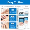 Keloid Bump Removal, Keloid Scar Treatment for Face, Body, Advanced