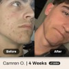 Shield System, Acne System for Men, Face Wash, Moisturizer, Pimple