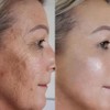 Solución Peeling Facial AHA BHA - Sérum Exfoliante Facial con