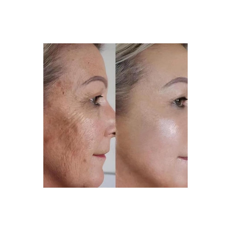 Solución Peeling Facial AHA BHA - Sérum Exfoliante Facial con