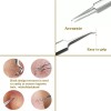 Margalla Int® Sharp Tweezers Blackhead Pimple Popper Remover Professional Skin