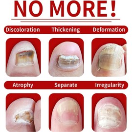 2Pcs Ginger Nail Growth Serum,7 Days Nail Treatmant,Nail Strengthener For Damaged Nails,Nail Nutrient Strengthener Ginger Nail Growth Oil for Natural Shine