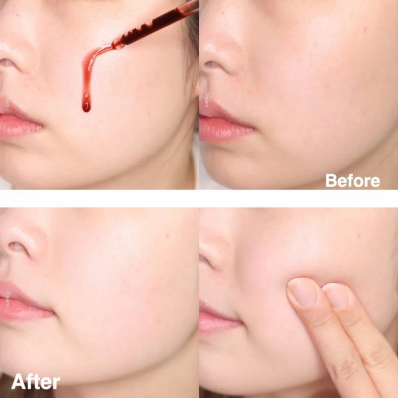 Skin1004 Zombie Beauty Bloody Peel 30ml Momento De Aplicación Noche