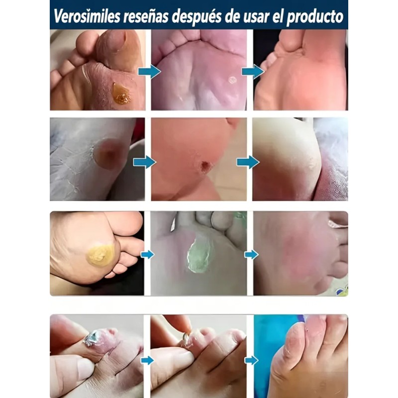 Crema Quitar Verrugas Genitales Efectiva 20g