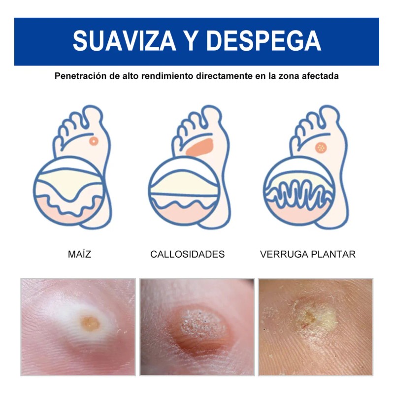Líquido De Eliminación De Verrugas Plantar Y Comunes 1pc