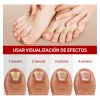 Fungicida Para Uñas Con Hongos, Amarillas,engrosadas Y Duras