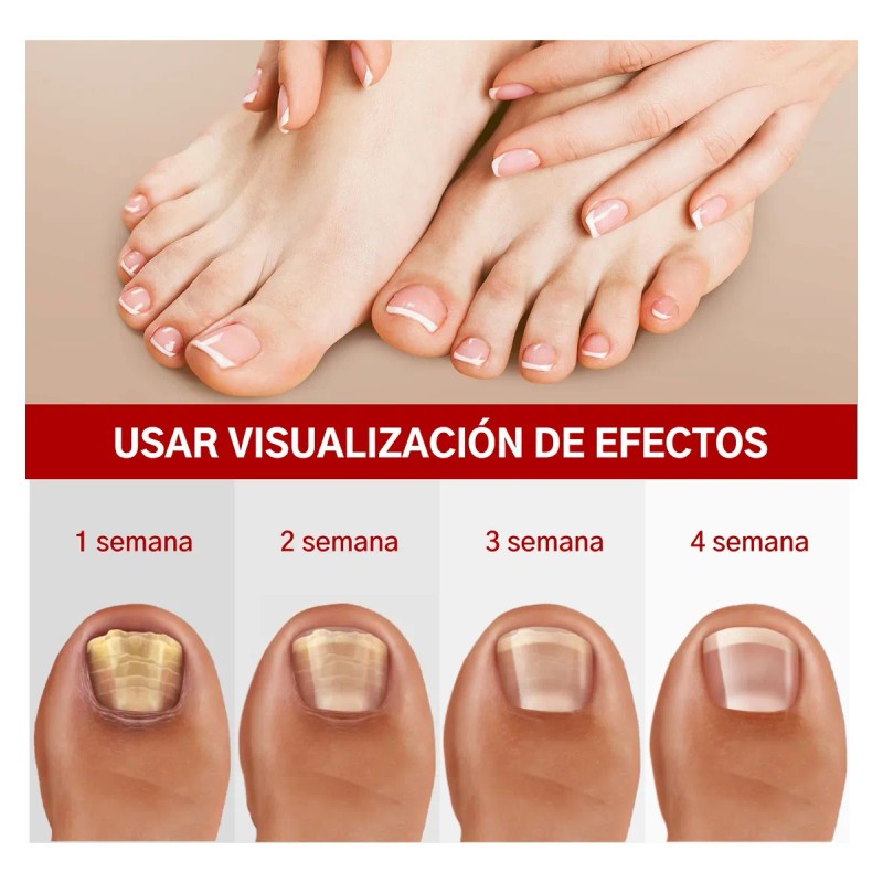 Fungicida Para Uñas Con Hongos, Amarillas,engrosadas Y Duras
